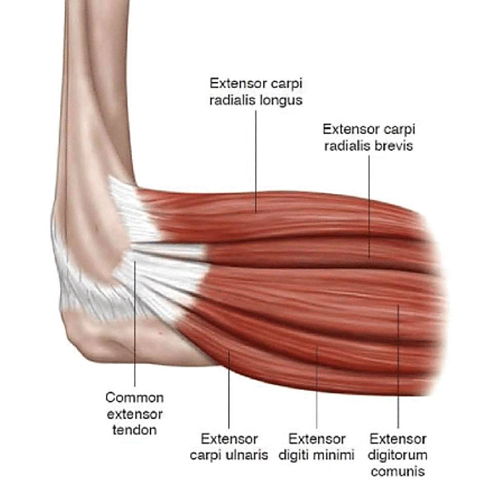 tennis elbow